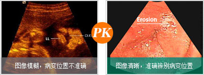 索諾聲體外胃腸檢優勢