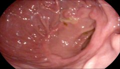 胃潰瘍的癥狀及治療方法