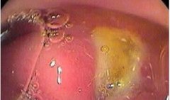 胃潰瘍有哪些檢查