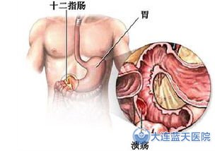 大連胃腸醫院專家解釋十二指腸炎的危害竟有哪些？